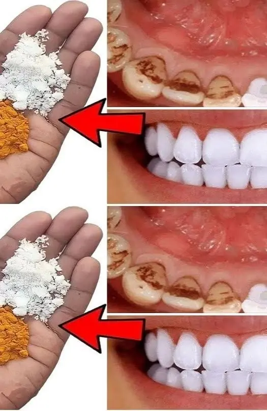 Can You Whiten Your Teeth at Home? What Really Works for a Brighter Smile