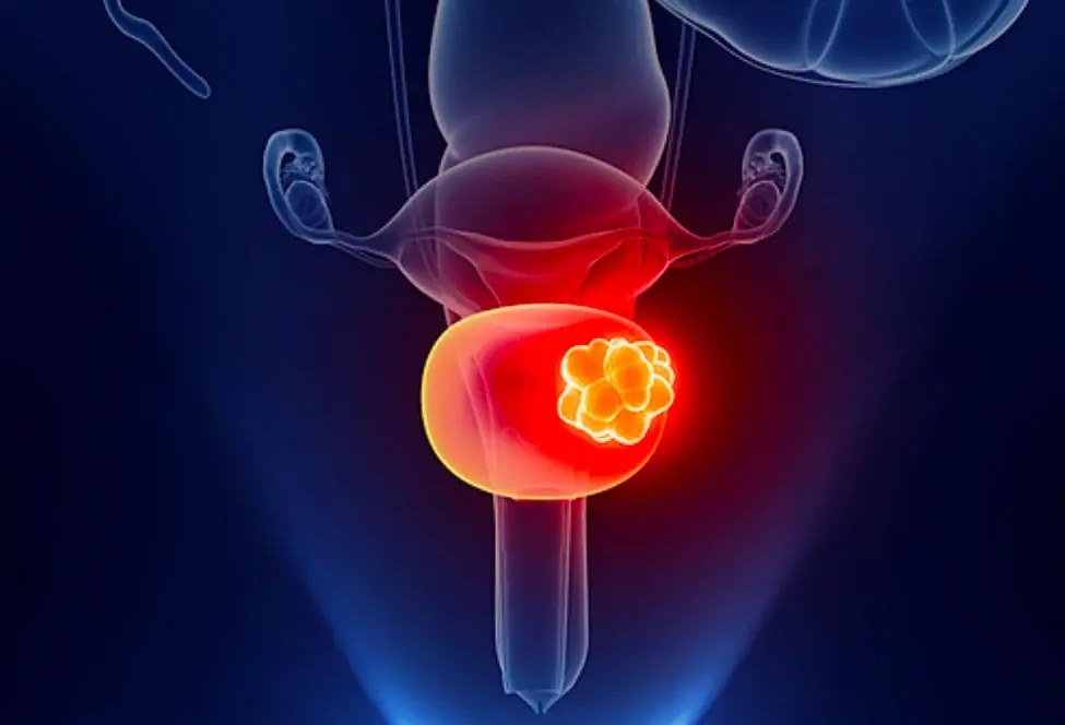 Doctors Say These 5 Early Bladder Cancer Symptoms Are Often Missed