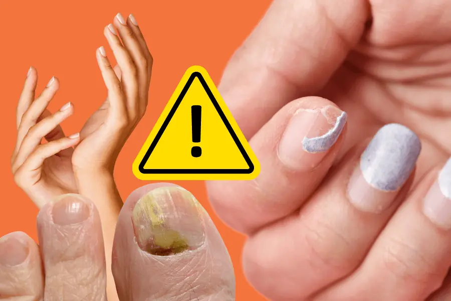 Nail Changes That Could Be Warning Signs of Health Problems
