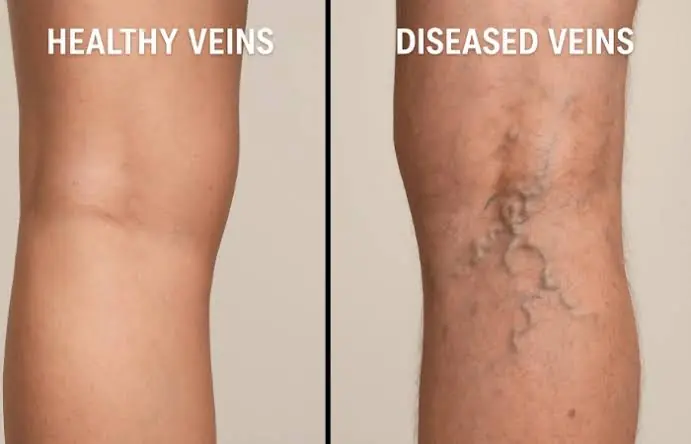 Visible Veins: Possible Causes and When They Could Signal a Health Problem