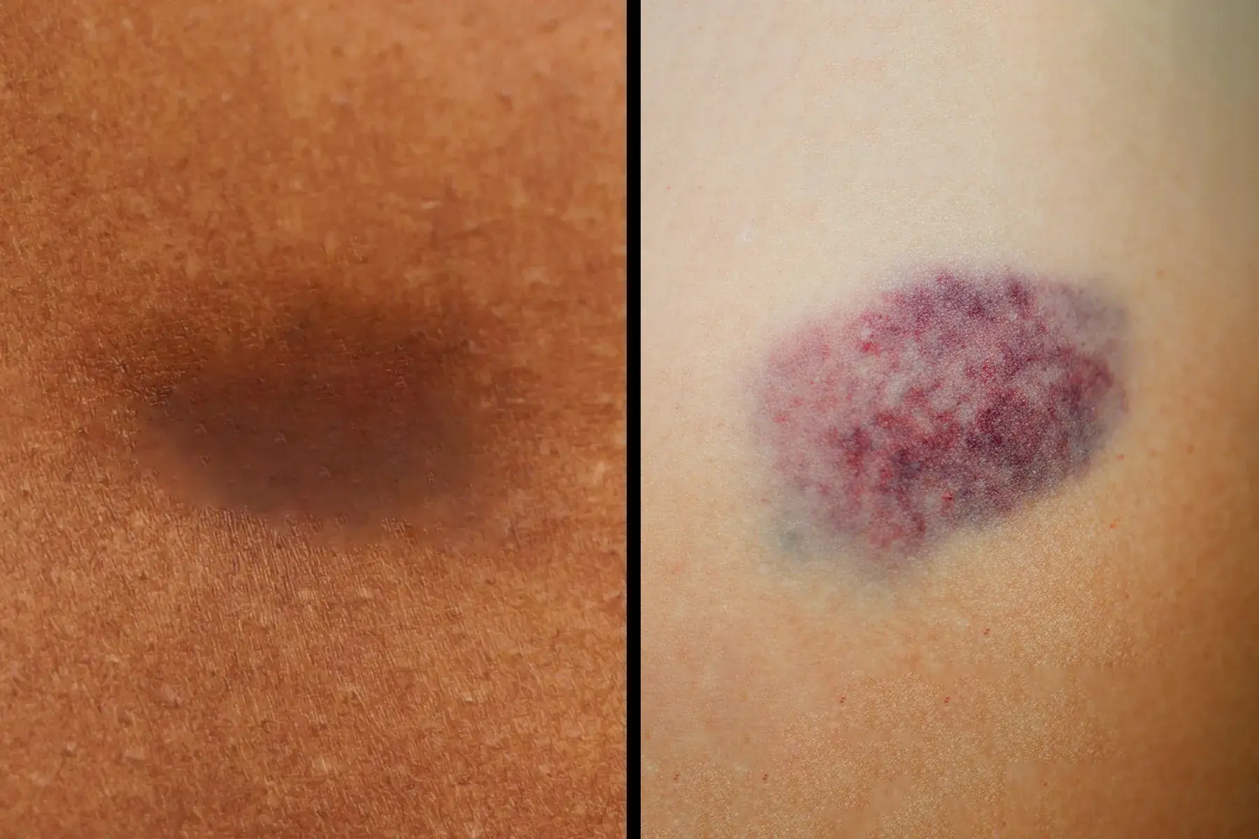 Doctors Say Unexplained Bruises Should Never Be Ignored — Here's Why