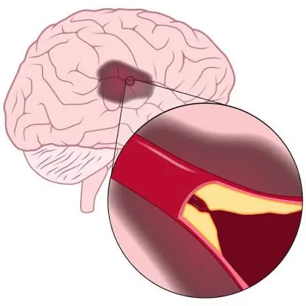 Could It Be a Mini Stroke? Learn the 5 Warning Signs