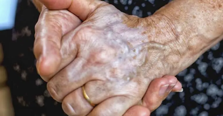 Visible Hand Veins: Often Harmless, But Sometimes Worth Checking