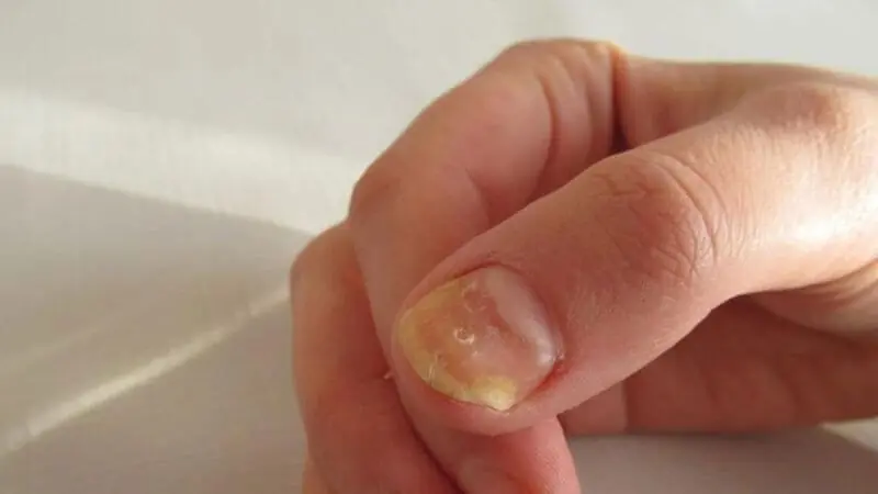 Weak or Splitting Nails? Here's What Medical Experts Want You to Know