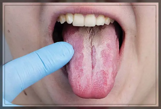 White Tongue:  Possible Causes and When You Should See a Doctor