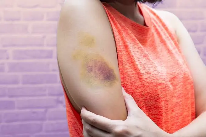 Bruising Easily?  Possible Reasons You Keep Getting Unexplained Bruises