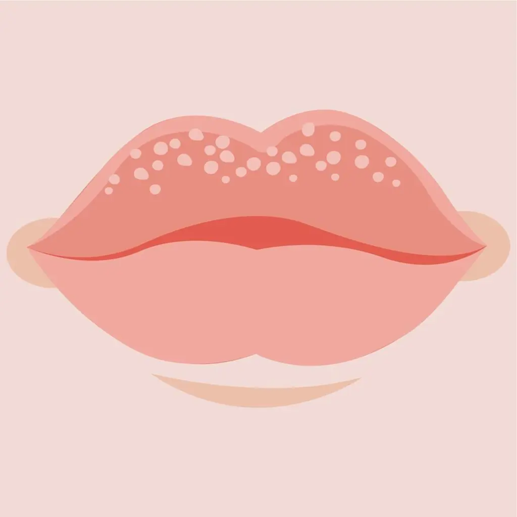White Bumps on the Lips or Genital Area: What They Could Mean and When to See a Doctor
