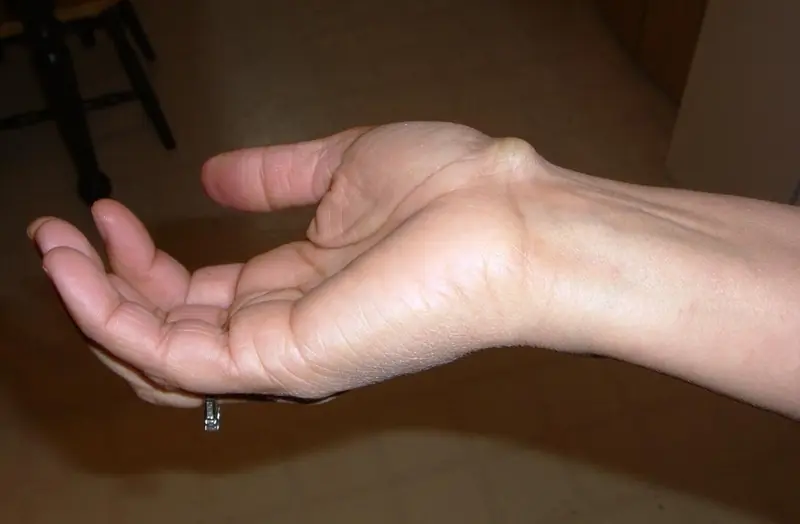 What a Small Wrist Bump May Mean: Understanding Ganglion Cysts