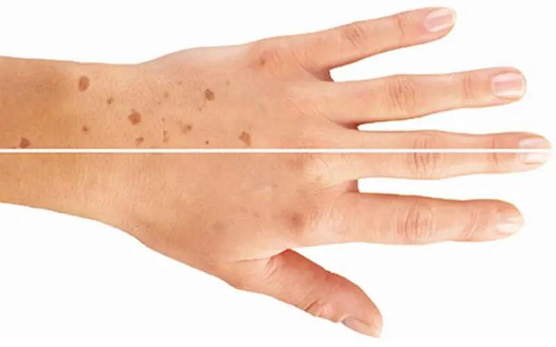 What Causes Spots on Your Hands? Here's What You Should Know