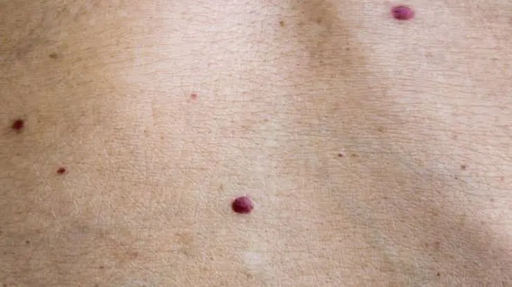 If You Notice Tiny Red Dots on Your Skin, Here's Why They May Matter