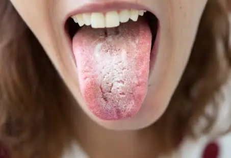 If Your Tongue Looks White, Here's What You Should Know