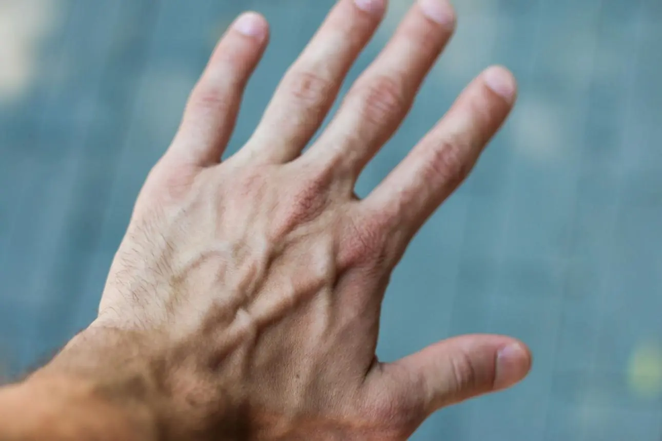 Visible Veins on Your Hands: What They Can Really Tell You About Your Health