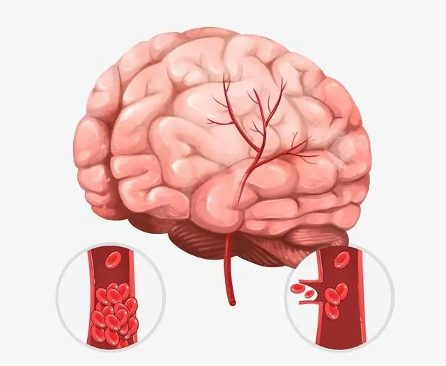 A Month Before a Stroke, Your Body May Send These 10 Warning Signs—Don't Ignore Them