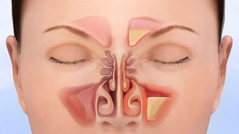 Natural Approaches That May Help Ease Sinus Pressure and Congestion