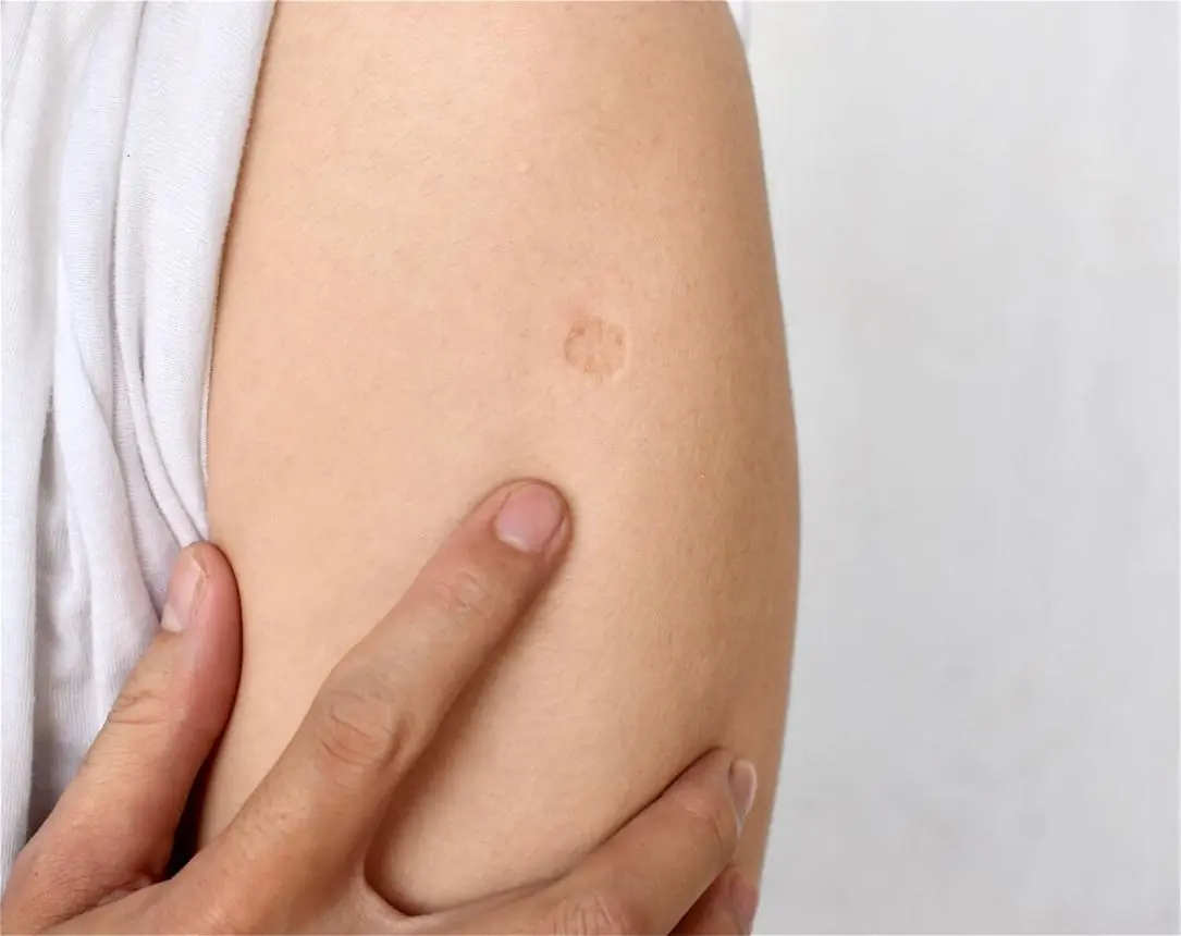 The Small Scar Many People Have Since Childhood: The Story Behind the BCG Vaccine Mark