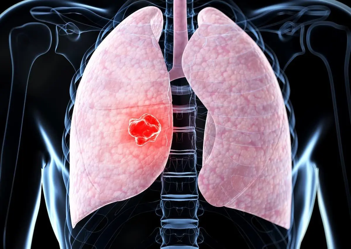Doctors Warn: Three Leg Symptoms Could Be an Unexpected Sign of Lung Can.cer