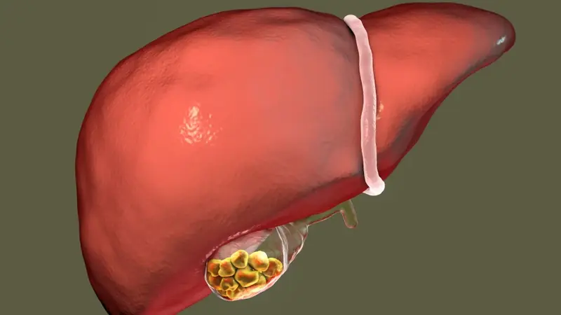 What to Expect After Gallbladder Surgery: 5 Potential Complications to Watch For
