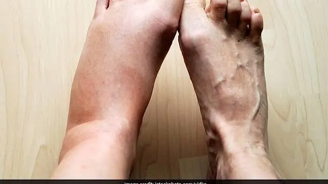 If Your Legs Are Frequently Swollen, It's Time to Pay Attention to Your Body