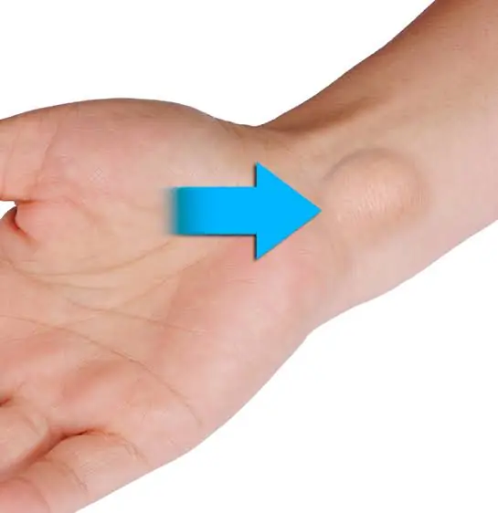 Your Body May Be Trying to Tell You Something Through This Unusual Lump