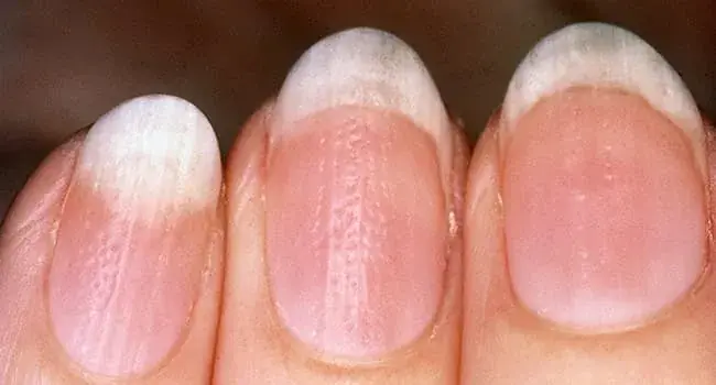 After 40, Even Small Changes in Your Nails May Be Worth Paying Attention To