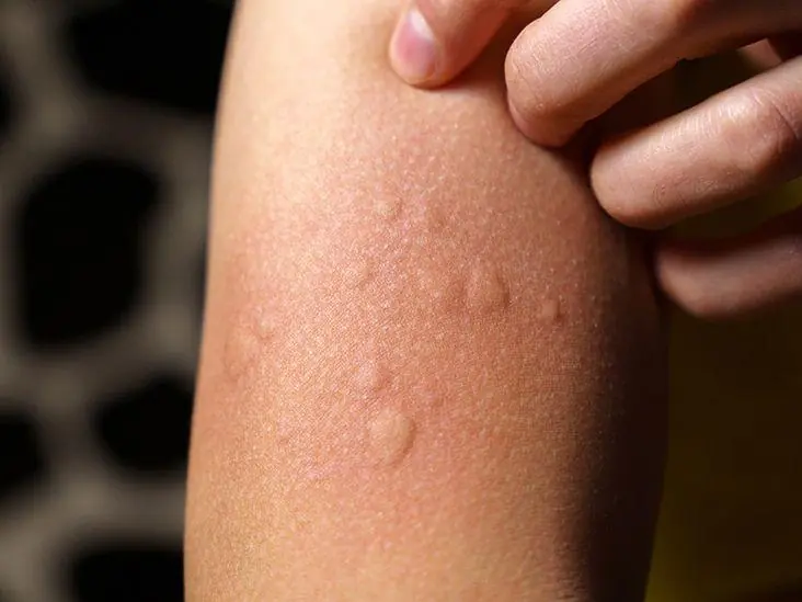 Itchy Skin with Raised Bumps? What Your Body May Be Trying to Tell You