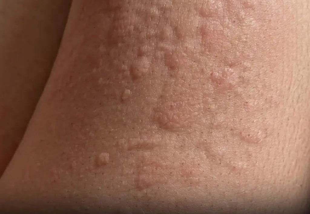 He Thought It Was Just an Allergy But the Diagnosis Revealed Something Unexpected...