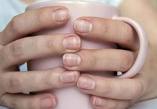 Your Fingernails Could Reveal Hidden Health Issues — Here Are the Signs