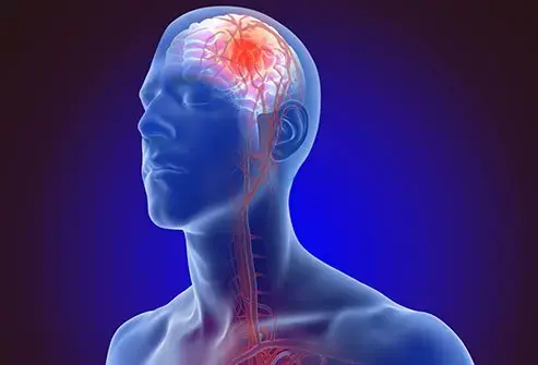 8 Warning Signs of Stroke That May Appear One Month Before — and 9 Ways to Help Reduce Your Risk