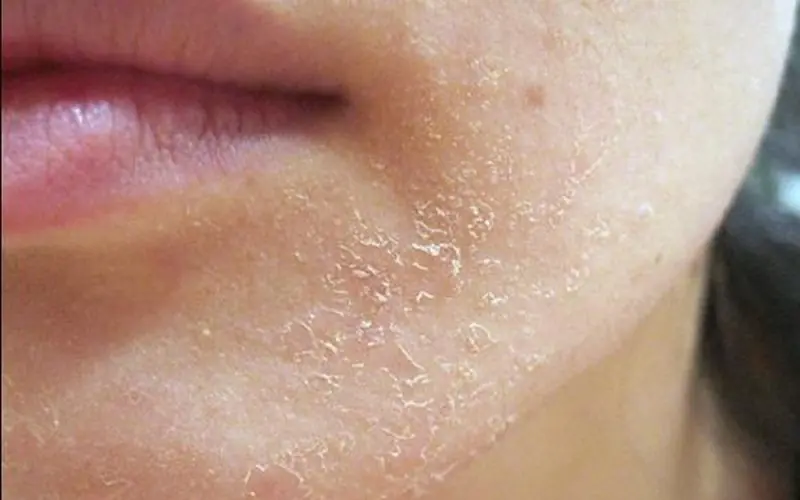 12 Everyday Tips That May Help Improve Dry Skin Naturally