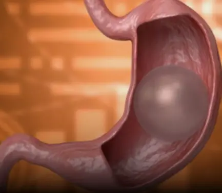 What happ:ens if the gastric balloon bur.sts?