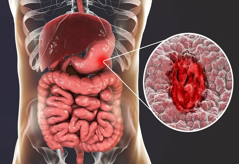 7 Symptoms That May Be Associated With Advanced Stomach Can.cer