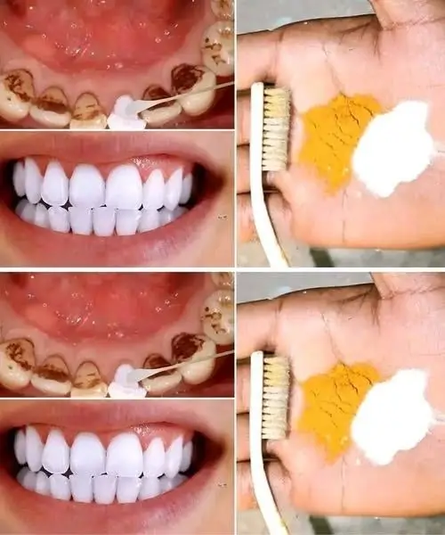 Home Teeth Whitening: Can You Get Whiter Teeth in Just 2 Minutes?