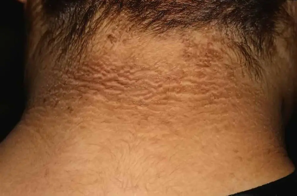 Skin Changes You Shouldn't Ignore: 12 Possible Signs of Diabetes