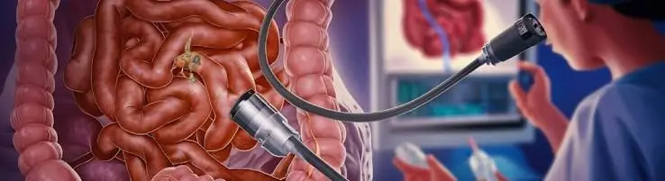If Your Doctor Suggests a Colonoscopy, Don't Miss This Information