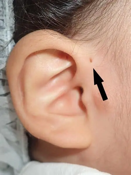Discover the Meaning of This Tiny Mark Near the Ear: It's More Common Than You Think