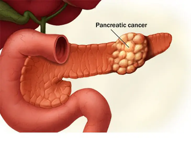 Pancreatic Can.cer: 11 Potential Warning Signs to Be Aware Of