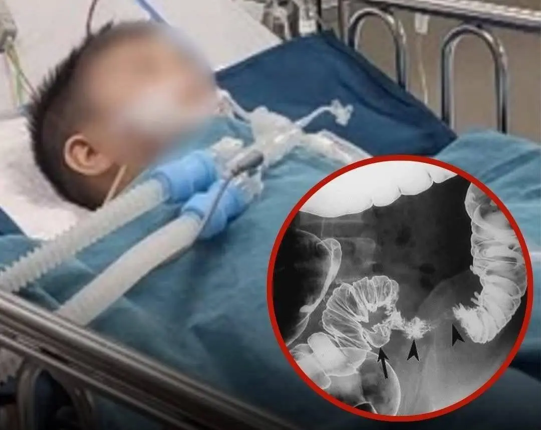 Second-Grader Diagnosed with Colon C.anc.er After Regularly Eating These 2 Foods Since Childhood