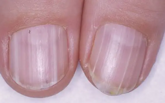 After 40, Your Nails Could Reveal More About Your Health Than You Expect