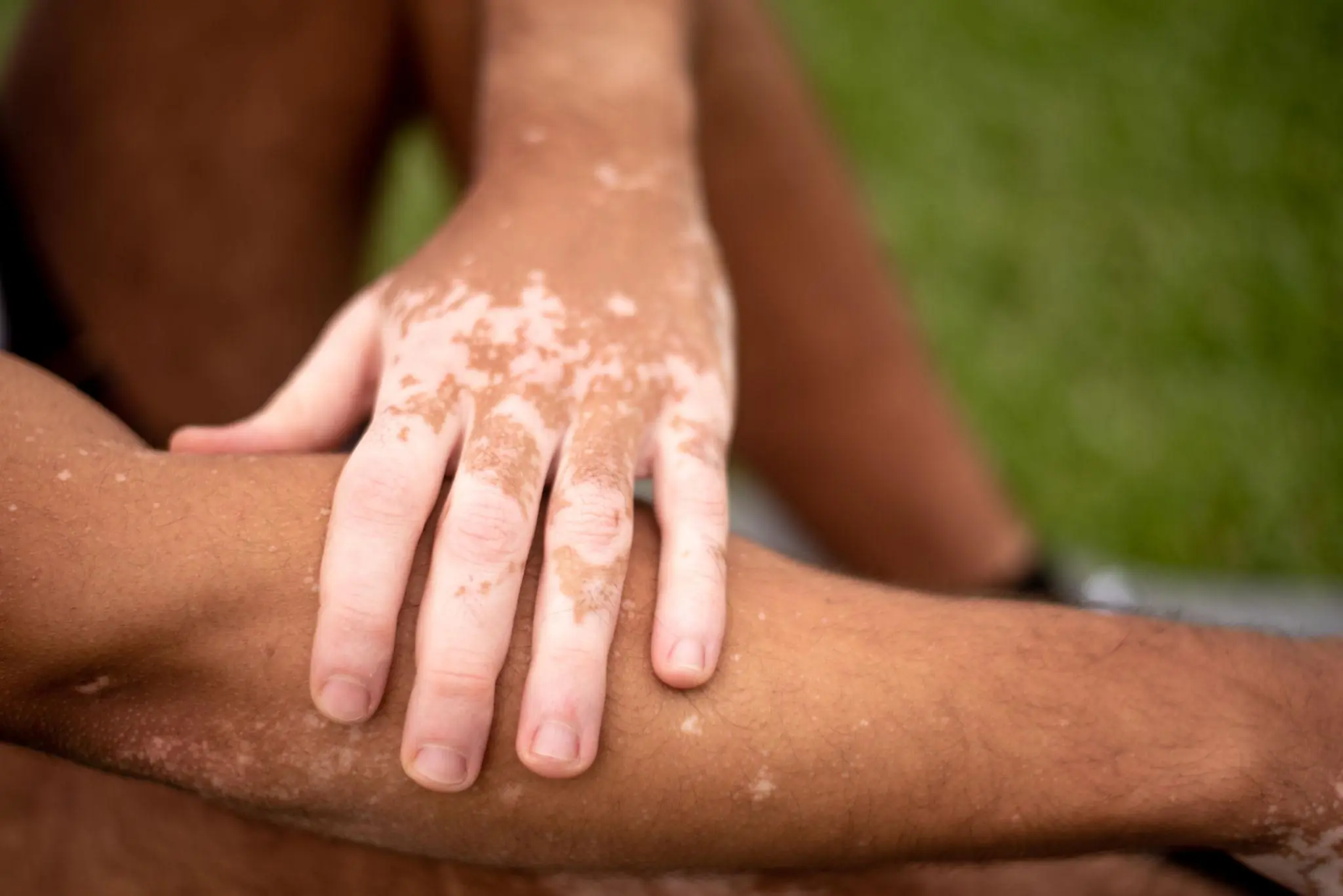 Those Tiny White Spots on Your Skin Could Be Trying to Tell You Something