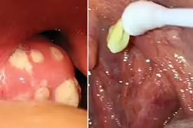 These Common Mouth Symptoms Might Be Early Warning Signs of an Underlying Condition