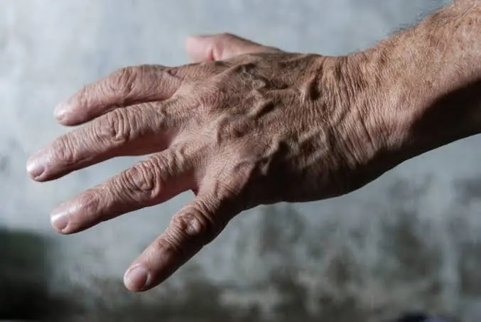 Visible Veins Can Have Many Causes—Some May Be Worth Paying Attention To...