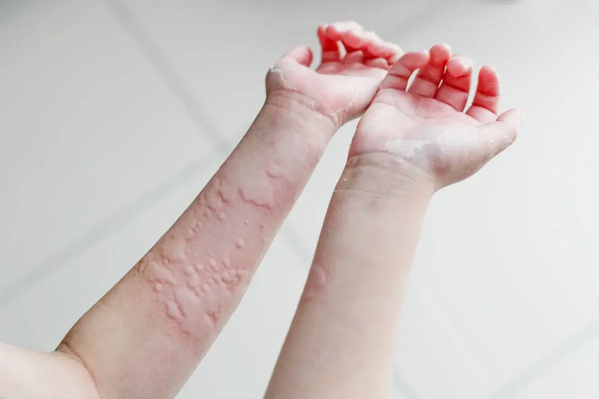 Hives (Urticaria): 10 Possible Causes You Should Know