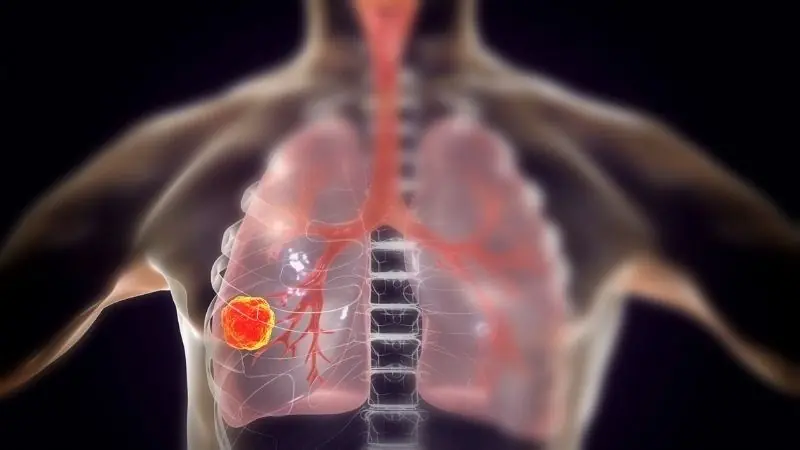 4 Morning Symptoms That May Be Associated With Lung Can.cer or Other Lung Conditions