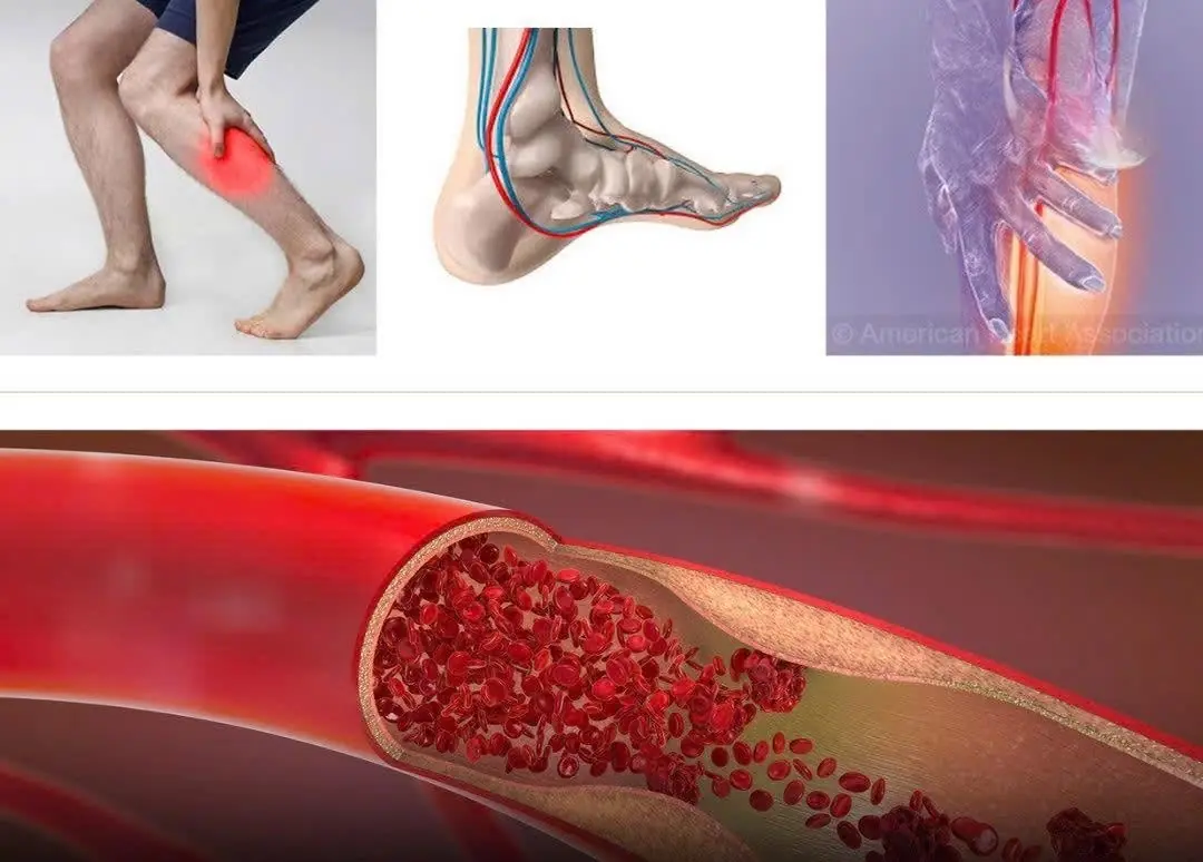 Hidden Signs of Heart Blockage: What Your Feet and Legs May Be Telling You at Night