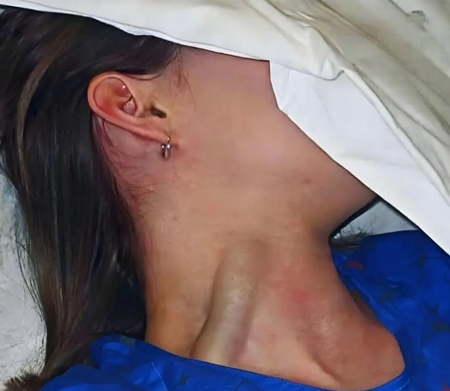 Jugular Vein Distension: Possible Causes and When to Seek Medical Care