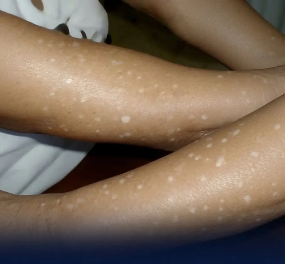 Experts Reveal What White Patches on Your Skin Could Be Trying to Tell You