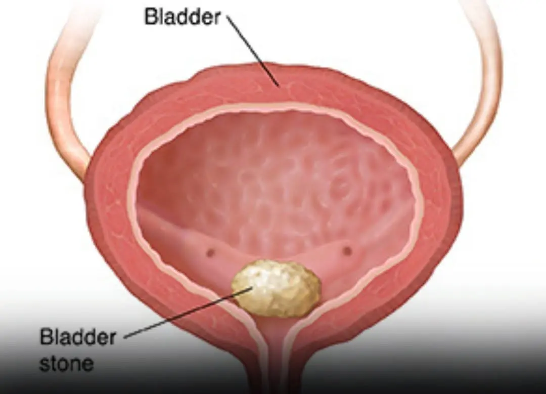 Is Your Body Sending a Signal? Early Signs of Bladder Can:cer