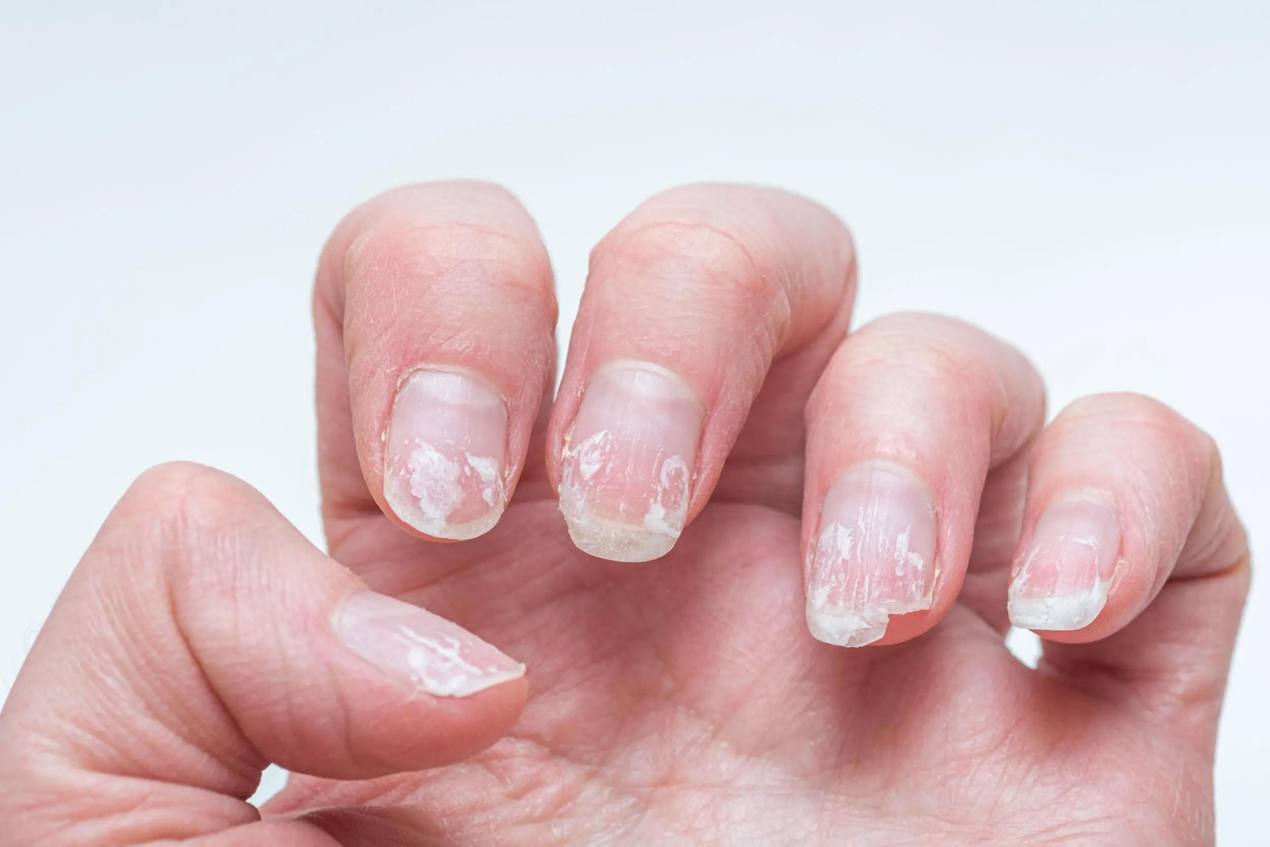 Brittle or Splitting Nails? Here’s What Your Body Might Be Trying to Tell You