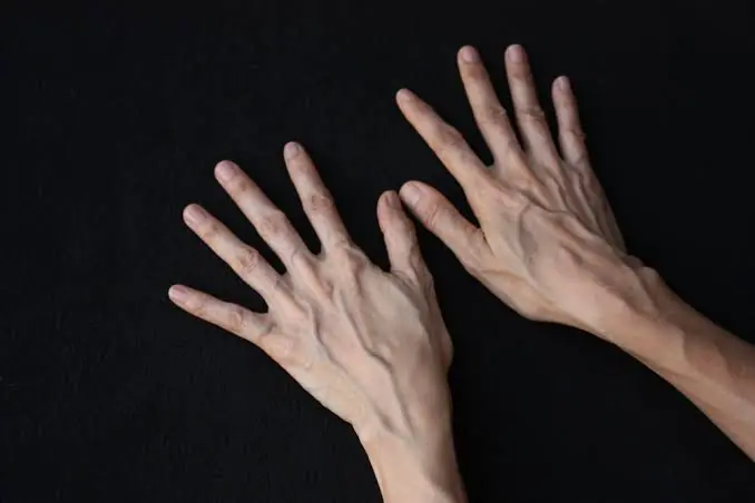 If the Veins in Your Hands Seem More Noticeable, Here's What Could Be Behind It