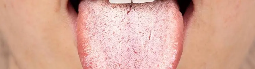 Wondering Why Your Tongue Is White? Here Are Some Possible Reasons